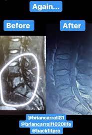 Briand MRI for back injury back pain