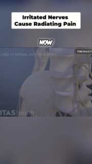 Most people think a bulging or herniated disc automatically explains their pain, but that’s rarely the full story.
In this video, I break down neurodynamics, radiating pain, sciatica, dermatomes, and why two people with nearly identical MRIs can experience completely different symptoms. Pain is not just about what shows up on imaging. It’s about what tissue is actually irritated, how the nervous system is behaving, and how your body responds to movement and load.
This is exactly why assessment matters more than blindly chasing MRI findings.
To watch the full video, click the link below, the link in bio, or the link on my story!
https://www.powerrackstrength.com/why-disc-pain-is-more-complex-than-most-people-think/
#BackPain #Sciatica #DiscBulge #SpineHealth #Neurodynamics