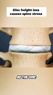 Not all spine injuries are the same, and treating them like they are is one of the biggest reasons people stay stuck.
A disc issue, facet overload, instability, bone stress, or a spinal segment that is starting to shift can all create very different symptoms. That is why the MRI label alone is not enough. You have to know what actually triggers the pain.
Is it flexion? Extension? Compression? Shear? Sitting? Standing? Walking? Training?
Once you know the mechanism, you can stop guessing and start building a plan that actually fits the injury.
Your spine is not fragile, but it is specific. The answer is not random exercises. The answer starts with assessment.
To watch the full video, click the link below, the link in bio, or the link on my story!
https://www.powerrackstrength.com/spine-injuries-are-specific-not-random/
#BackPain #SpineHealth #BackMechanic #StuartMcGill #BrianCarroll