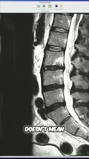 You are not your MRI.
This case was a professional football player who came in with severe stabbing back pain, radiating symptoms down both legs, and deep aching through the low back. He could not sit, stand, walk, bend, twist, flex, extend, or compress without setting off pain.
He had already been told he may need a multi-level spinal fusion. But once we assessed him, we found the real priority was identifying what movements and postures were provoking his symptoms, removing those triggers, and finding positions of reprieve so his back could finally calm down.
The MRI mattered, but it was only one piece of the picture. We treated the person — not just the image.
Two months later, even though the MRI still showed damage, he was nearly pain-free, no longer dealing with the same radiating symptoms, and had started rebuilding pain-free capacity.
To watch the full video, click the link below, the link in bio, or the link on my story!
https://www.youtube.com/watch?v=V6bctq9ekSA
#BackPain #BackMechanic #SpineHealth #DiscHerniation #PowerRackStrength