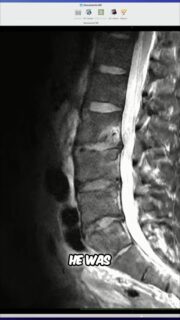 You are not your MRI.
This case was a professional football player who came in with severe stabbing back pain, radiating symptoms down both legs, and deep aching through the low back. He could not sit, stand, walk, bend, twist, flex, extend, or compress without setting off pain.
He had already been told he may need a multi-level spinal fusion. But once we assessed him, we found the real priority was identifying what movements and postures were provoking his symptoms, removing those triggers, and finding positions of reprieve so his back could finally calm down.
The MRI mattered, but it was only one piece of the picture. We treated the person — not just the image.
Two months later, even though the MRI still showed damage, he was nearly pain-free, no longer dealing with the same radiating symptoms, and had started rebuilding pain-free capacity.
To watch the full video, click the link below, the link in bio, or the link on my story!
https://www.youtube.com/watch?v=V6bctq9ekSA
#BackPain #BackMechanic #SpineHealth #DiscHerniation #PowerRackStrength