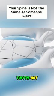 A disc herniation does NOT mean you’re sentenced to a lifetime of back pain.
One of the biggest mistakes I see is people getting an MRI, seeing words like “disc herniation” or “disc bulge,” and assuming their injury is the same as everyone else with that same label. It isn’t.
Your spine is a complex system. The discs, vertebrae, muscles, ligaments, joints, nervous system, hips, and surrounding structures all work together. When one area stops moving or functioning the way it should, another area often compensates.
That’s why the mechanism behind your pain matters so much more than simply reading the diagnosis on your MRI report.
You need to understand what YOUR spine is doing, what movements are provoking the problem, and where compensation may be occurring. That starts with a proper assessment.
To watch the full video, click the link below, the link in bio, or the link on my story!
https://www.youtube.com/watch?v=RiV0ms7L62g
#BackPain #DiscHerniation #SpineHealth #LowBackPain #BackPainRecovery