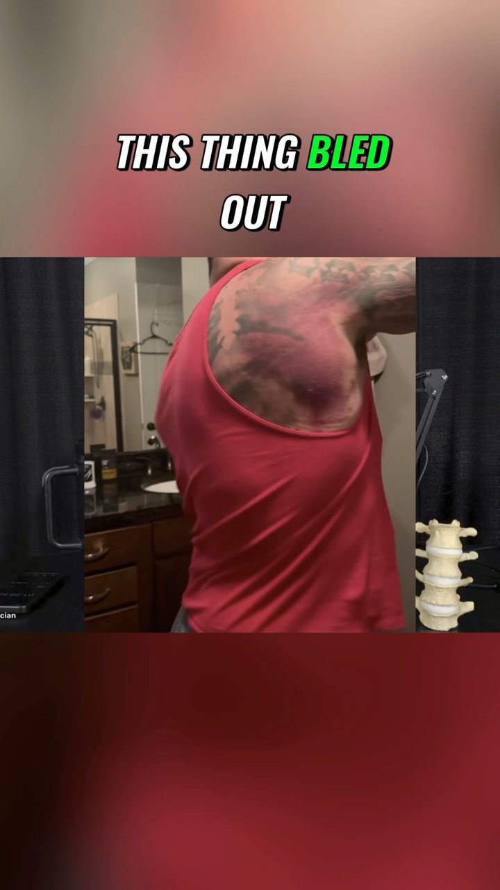 I managed to tear up both shoulders within a matter of months, but I was still able to work my way back to pressing, rowing, carrying, and grappling without completely shutting training down.
The biggest lesson was simple: you cannot rely on recovery tools while ignoring the mechanical problem that keeps irritating the injury. Shoulder stabilization, thoracic mobility, rowing, smart training adjustments, peptides, and microcurrent all played a role in my process.
If you would like to watch the full video, please click the link below, the link on my Instagram story, or the link on my LinkTree located in my bio!
https://www.powerrackstrength.com/how-i-rebuilt-both-shoulders-and-got-back-to-training/
#ShoulderRehab #StrengthTraining #InjuryRecovery #Powerlifting #ShoulderHealth
